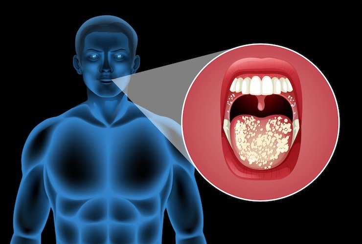 Kissing Disease Kissing Disease