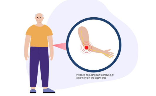 Cubital Tunnel Syndrome Surgery