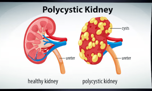 Polycystic Kidney Disease Polycystic Kidney Disease